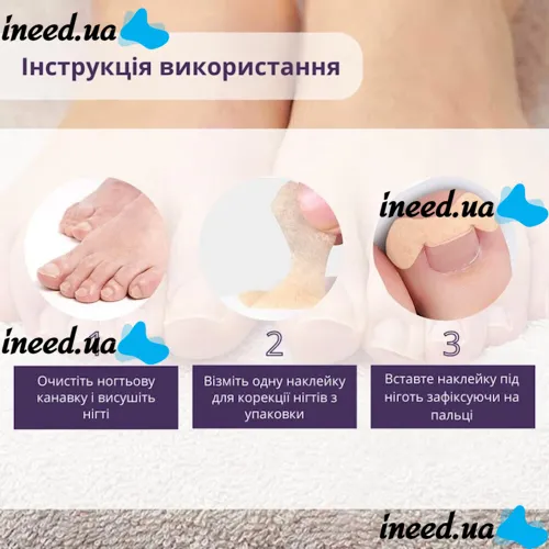 Набор пластырей Elastic Toenail Correction Sticker 50 шт для коррекции врастающих ногтей Телесный пластырь наклейка для устранения вросшего ногтя