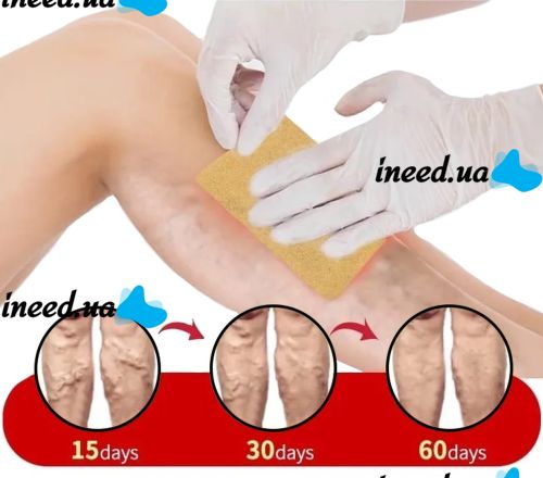 Телесный пластырь от варикоза KanyeHB Varicose Veins Plaster 6 шт, Комплект патчей от варикозного расширения вен и васкулита, Антиварикозные пластыри