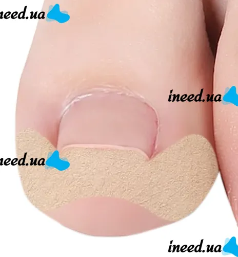 Набор пластырей Elastic Toenail Correction Sticker 50 шт для коррекции врастающих ногтей Телесный пластырь наклейка для устранения вросшего ногтя